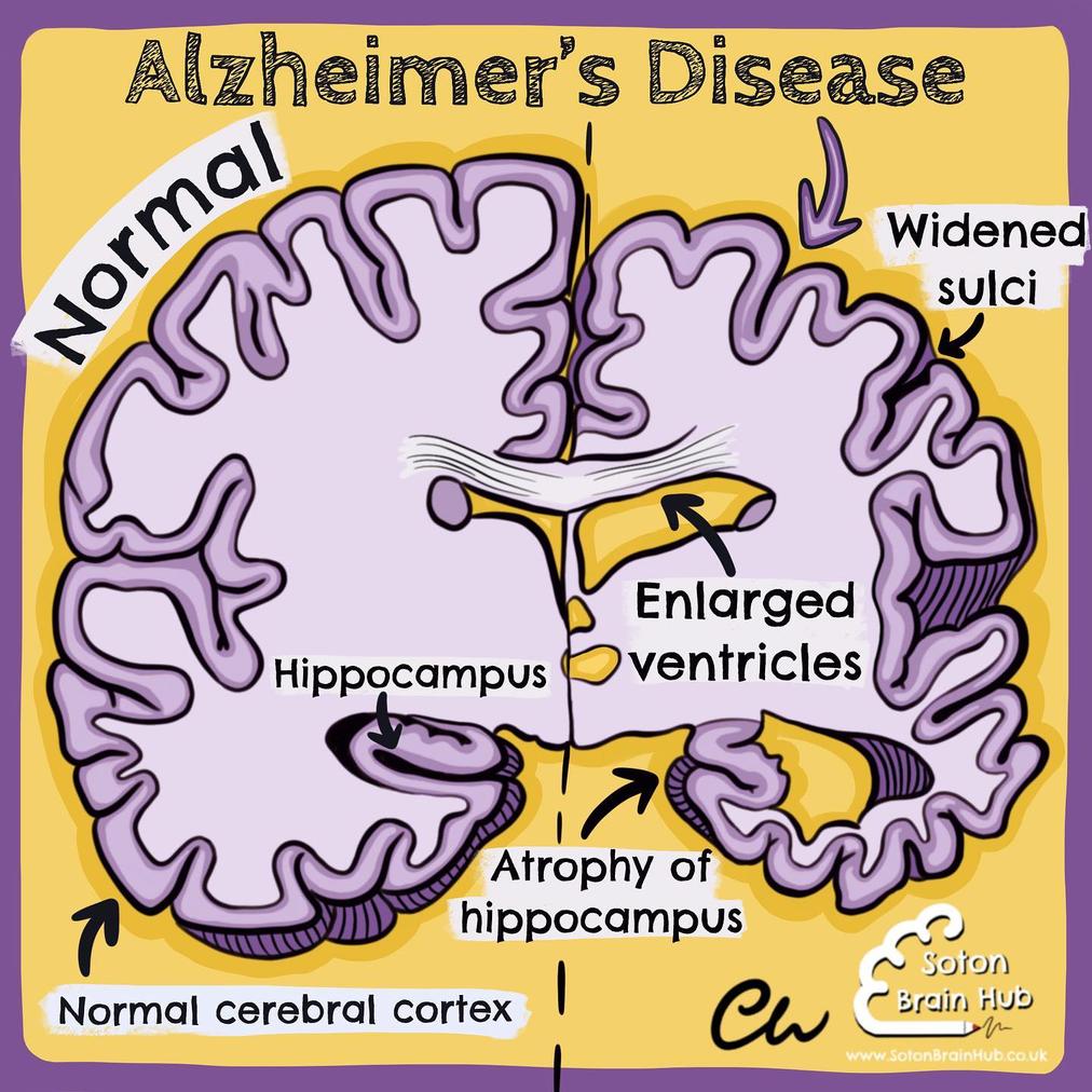 Alzheimer